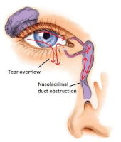 Endoscopic DCR